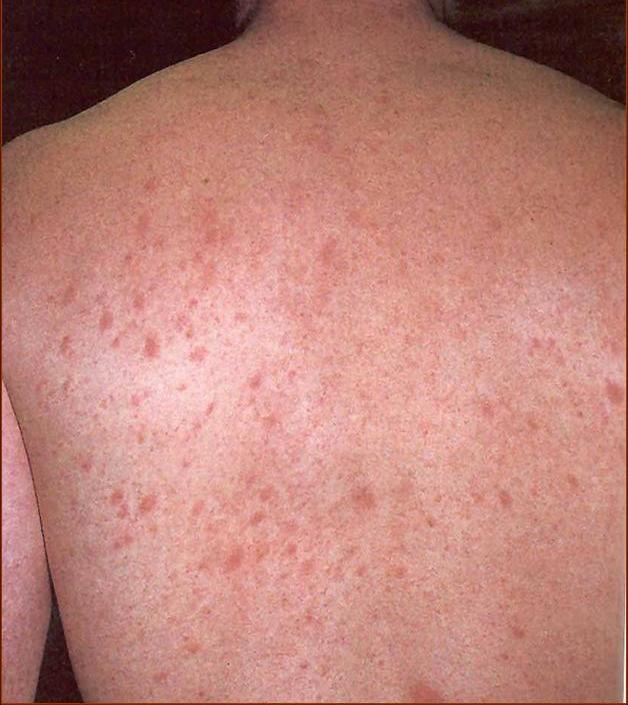 pityriasis rosea pictures #10