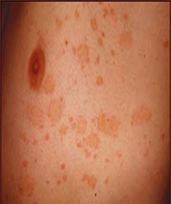 Pityriasis Rosea Pictures, Treatment & Causes - MedicineNet